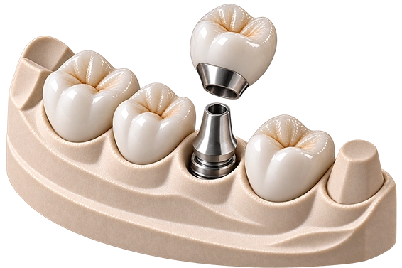 VMK-Krone auf Implantat