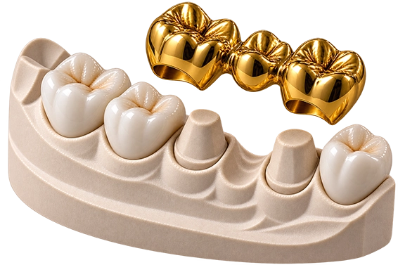 Vollgussbrücke Gold