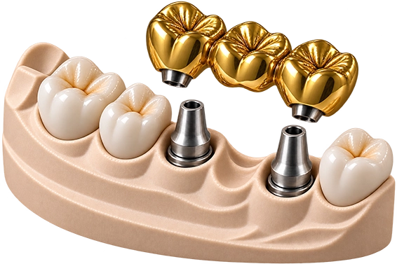 Zahnimplantat - Implantatbrücke Vollguss Gold