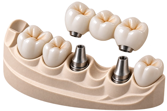 Implantatbrücken