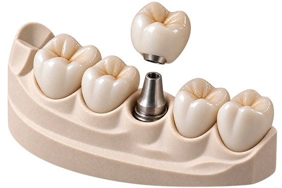 Implantatkronen